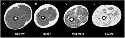 Image-to-Image Translation for Simplified MRI Muscle Segmentation